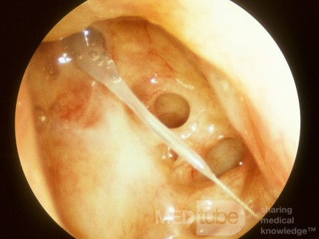 Postoperative Agger Remnant