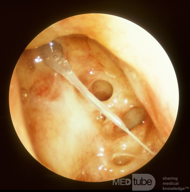Postoperative Agger Remnant
