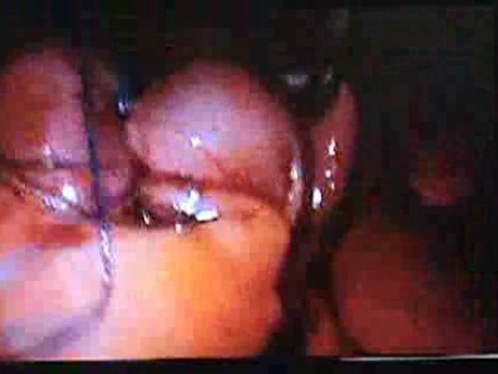 Jejunal Gastrointestinal Stromal tumor (GIST) (80 of 86)