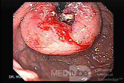 Gastric Cancer