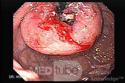 Gastric Cancer