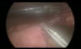 Small Bowel Perforation in Abdominal Trauma - Laparoscopic Approach