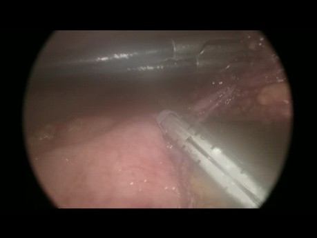 Small Bowel Perforation in Abdominal Trauma - Laparoscopic Approach