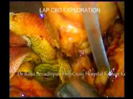 Laparoscopic CBD Exploration