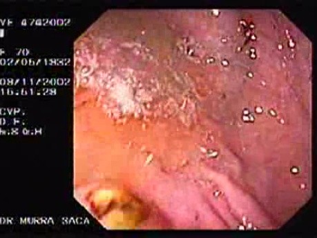 Dieulafoy´s Lesion (Exulceratio Simplex) (1 of 11)