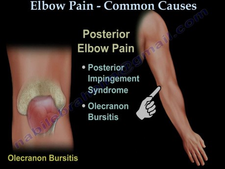 Common Causes of Elbow Pain - Video Lecture