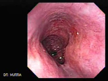 Barrett's Esophagus of long segment -state one month after Argon Plasma Coagulation (17 of 24)