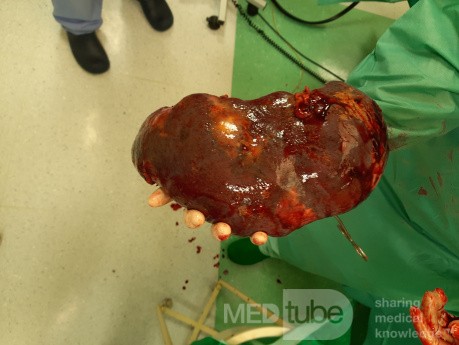 Spontaneous Rupture of CLL Spleen