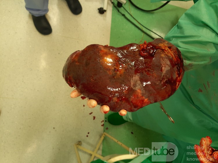Spontaneous Rupture of CLL Spleen