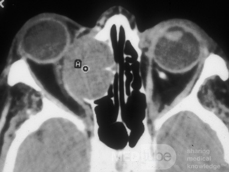 Large Frontoethmoidal Mucocele with Expansion into the Orbit [CT axial scann]