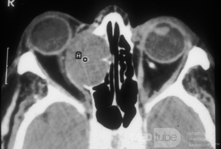 Large Frontoethmoidal Mucocele with Expansion into the Orbit [CT axial scann]