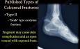 Heel Bone Injury & Calcaneal Avulsion Fractures - Video Lecture
