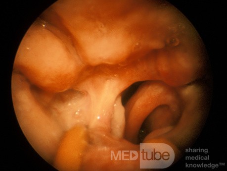 Unilateral Choanal Atresia