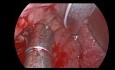 Haemostasis of Post-Tonsillectomy Bleeding