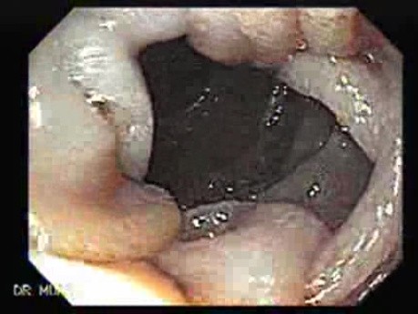 Angiodysplasia of the Duodenum (1 of 4)