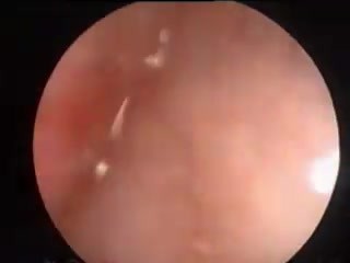 Vaginal Bleeding Caused By Polyp of the Endometrium