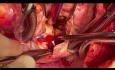 Patient with LV Tumor and Simultaneous Mitral and Aortic Valves Injury