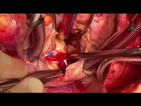 Patient with LV Tumor and Simultaneous Mitral and Aortic Valves Injury