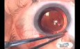 Glaucoma TCF Surgery with use Fugo Blade
