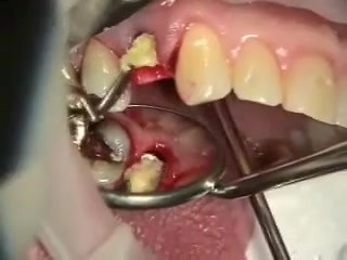 Provisional Immediate Implant After Tooth Extraction