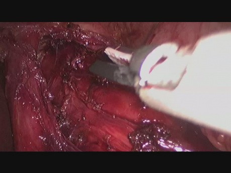 Laparoscopic treatment of achalasia - Heller's cardiomyotomy with Dor fundoplication