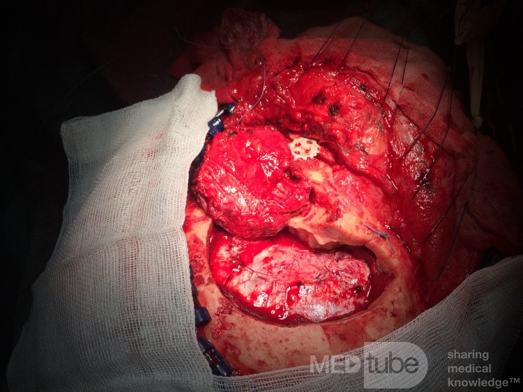 Meningioma resection – OZO (orbitozygomatic osteotomy)