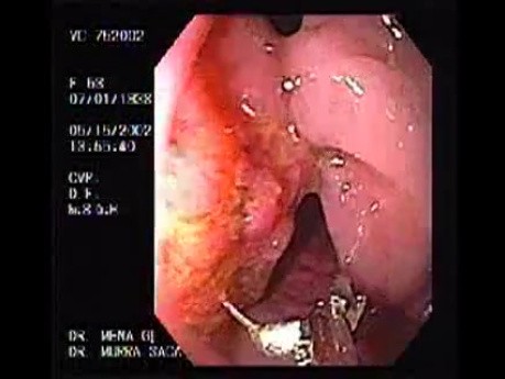 Enormous Tubulovillous tumor (1 of 2)