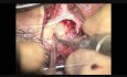 Bone Bridge Bone Conduction Implant in the Retrosigmoid Area