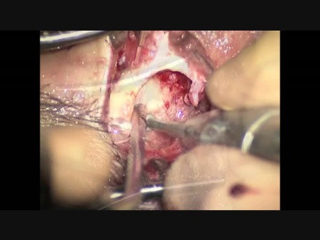 Bone Bridge Bone Conduction Implant in the Retrosigmoid Area