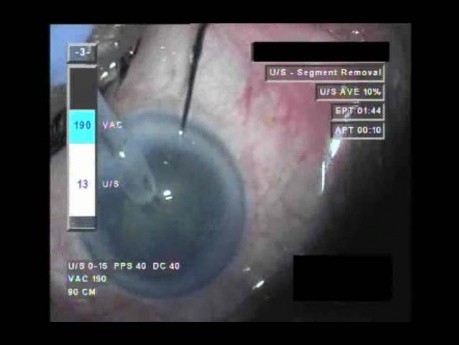 Cataract Surgery XII - Part 3