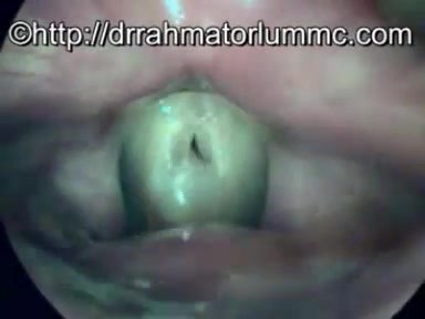 'Cup & Saucer' Effect-Vocal Fold Cyst