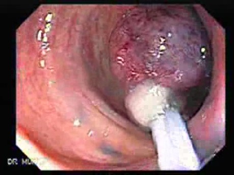 Colonoscopic Polypectomy (17 of 23)