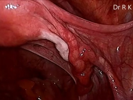 Total Laparoscopic Hysterectomy by Mishra's Knot