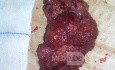 Large Villous Adenoma Removed by TEO