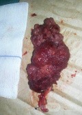 Large Villous Adenoma Removed by TEO