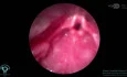 Rare Subglottic Hemangioma Causing 50% Obstruction of the Subglottic Space