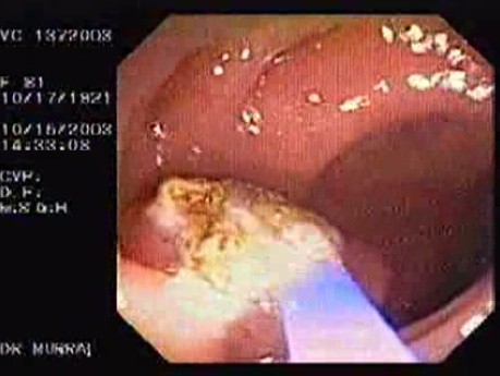 Tubulo - Villous Adenoma - Endoscopy (13 of 28)