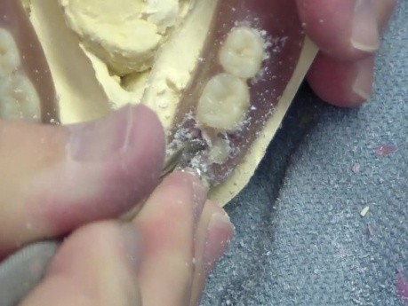 Dental Lab Outtakes - Tooth On The Move - Part 1/2 : Denture Repair