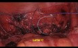 Vaginal Vault Suturing Tips and Technique