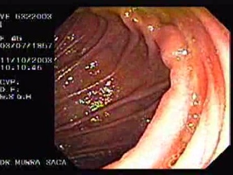 Enteroscopy (2 of 3)