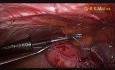 TLH with Bilateral Salpingo Ophorectomy