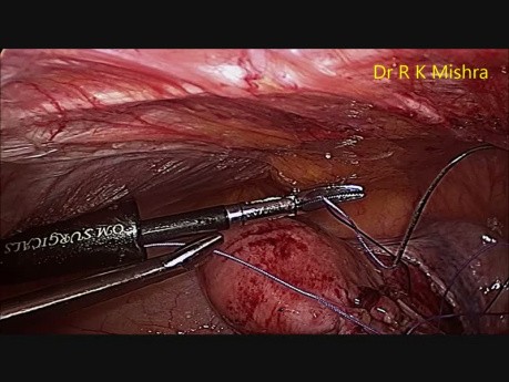 TLH with Bilateral Salpingo Ophorectomy