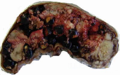 Gallbladder Adenocarcinoma and litiasis (3 of 13)