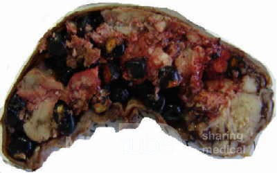 Gallbladder Adenocarcinoma and litiasis (3 of 13)