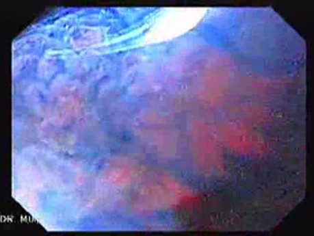 Gastric Polyp (7 of 7)