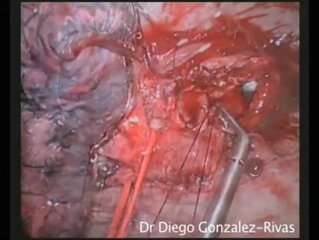 Single Port Sleeve Right Upper Lobectomy After Chemotherapy.