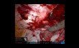 R PeTEP Suprapubic Diastasis Recti Repair with Inan Inverting Plication Suture IIPS