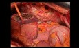 Transversectomy En Bloc With Segmental Gastric Resection, Atypical 2-3 Hepatectomy and Partial Resection of the Diaphragm and Pericardium for a Locally Advanced Transverse Colon Adenocarcinoma