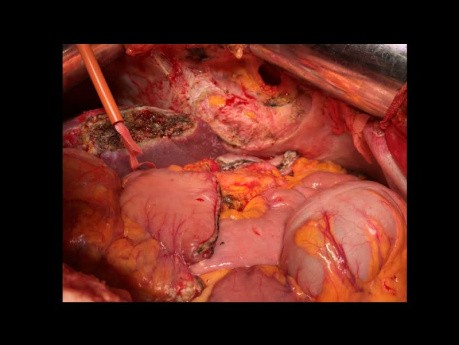 Transversectomy En Bloc With Segmental Gastric Resection, Atypical 2-3 Hepatectomy and Partial Resection of the Diaphragm and Pericardium for a Locally Advanced Transverse Colon Adenocarcinoma