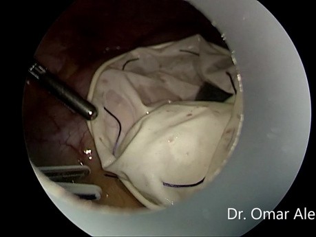 Laparoscopic Salpingectomy for Ectopic Pregnancy